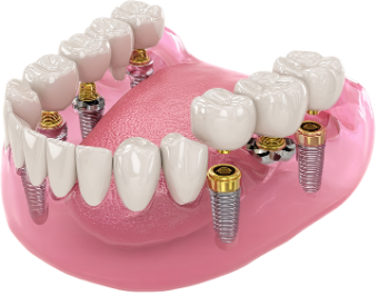 Implant Bridge