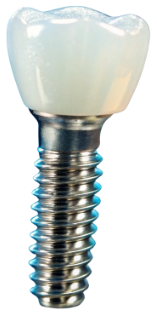 Implant, Abutment, Crown