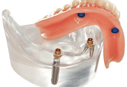 Overdenture