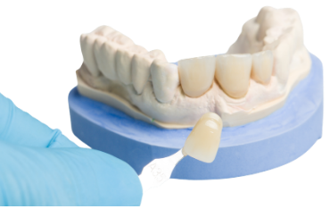 Veneers